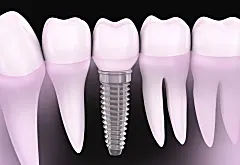 Dental implants cost in 2019 may surprise you