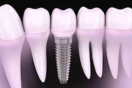 Here's What New Dental Implants Should Cost in 2019