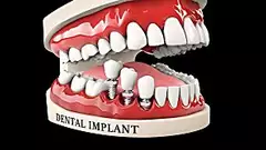 Dental Implants Are More Affordable Than Ever