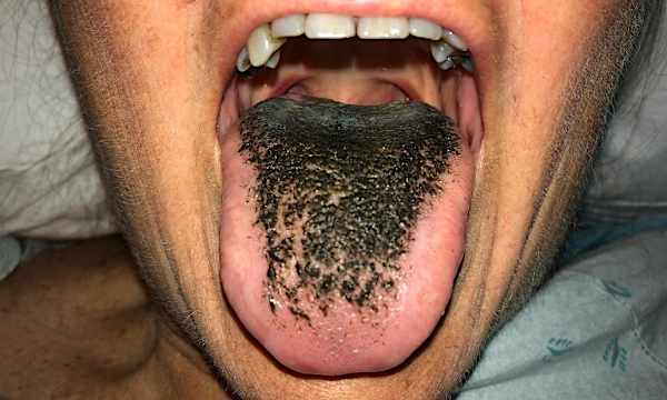 Black 'hair' on your tongue? Here's what that could be