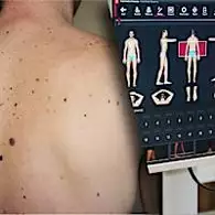 Ξέρεις πώς ανιχνεύεται ο καρκίνος του δέρματος; Ξέρεις πώς ανιχνεύεται ο καρκίνος του δέρματος;