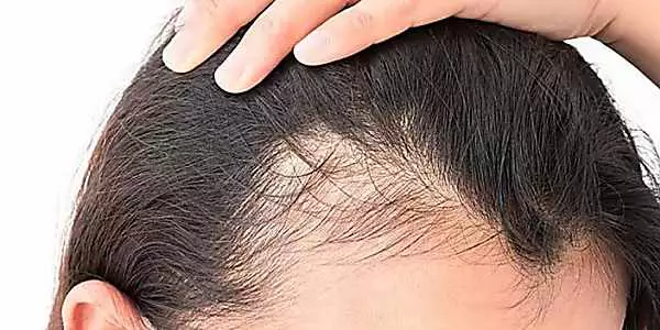 5cm de cabelo por ms: careca descobre frmula para ativar folculos capilares mortos