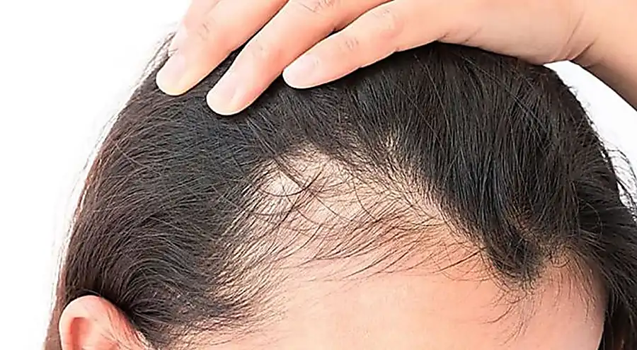 5cm de cabelo por mês: careca descobre fórmula para ativar folículos capilares mortos