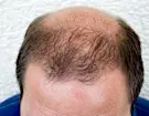 Anvisa: Ervas indígenas ativam folículos do cabelo e combatem a calvície