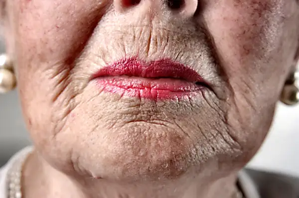 Ρυτίδες στο στόμα σε μεγάλη ηλικία: Αυτή η πανάρχαια θεραπεία βοηθά