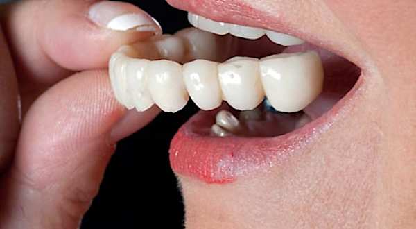 Campo Grande: Os preços atuais para implantes dentários podem te surpreender