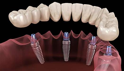 Esto es lo que los nuevos implantes dentales debería costar