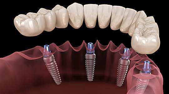Esto es lo que los nuevos implantes dentales debería costar
