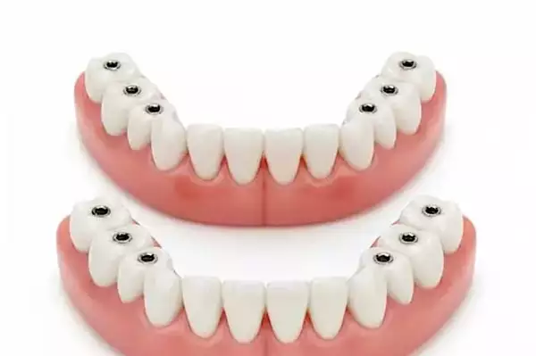 Ενδεικτικό Κώστος Οδοντικών Εμφυτευμάτων στην Ελλάδα (2026) Ενδεικτικό Κώστος Οδοντικών Εμφυτευμάτων στην Ελλάδα (2026)