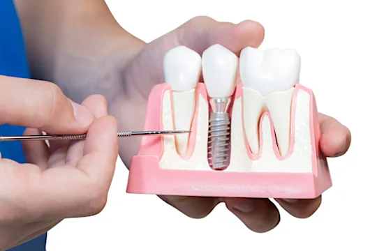 Accra: The Cost of Dental Implants in Dubai May Surprise You