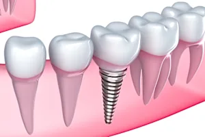 Here's What Full Mouth Dental Implants Should Cost You In 2023