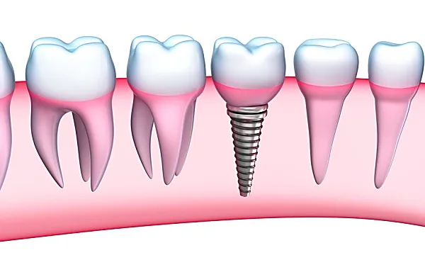 Here is what dental implants might cost you in Toronto