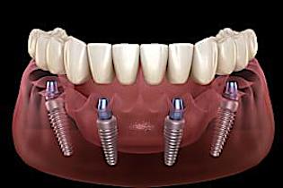 Ecco i veri prezzi degli impianti dentali nel 2021