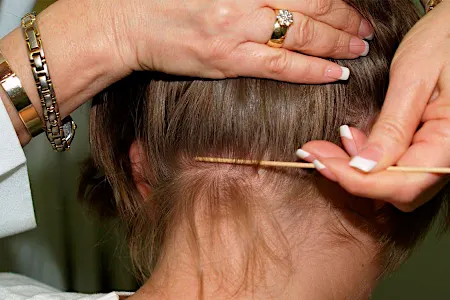 What Is Scalp Psoriasis? See Symptoms and Treatments