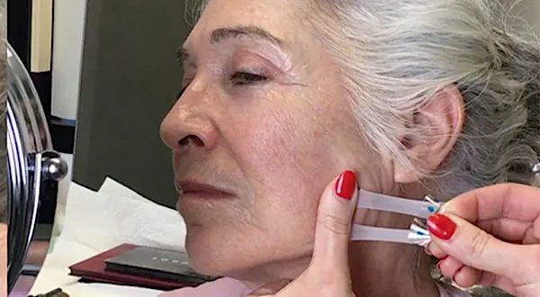 Botox é passado! Novo ácido melhora até 63% da pele enrugada