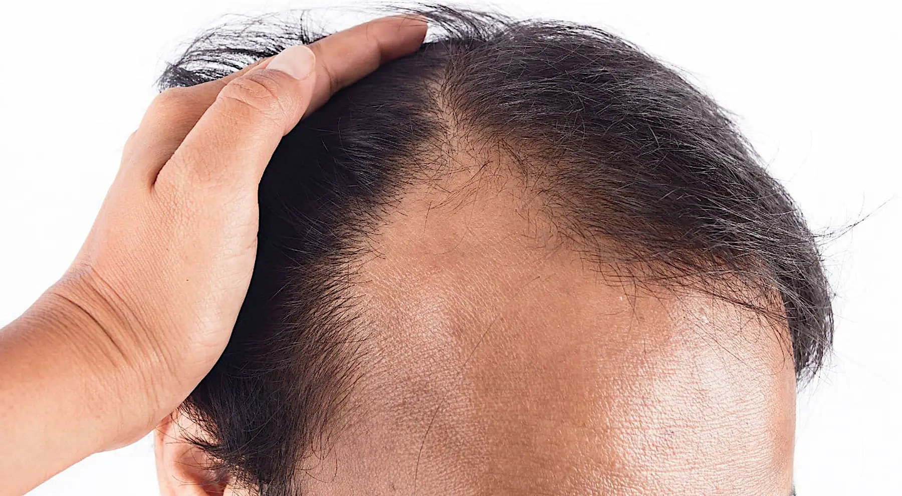 Anvisa substitui Minoxidil por uma nova fórmula 8x mais anti-calvície Anvisa substitui Minoxidil por uma nova fórmula 8x mais anti-calvície