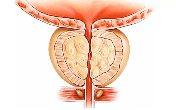 Prostate : une astuce simple pour r&eacute;duire sa taille (&agrave; faire tous les jours)