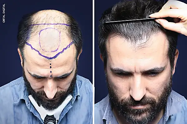 Ο γιατρός από την Τουρκία που ανέπτυξε μια καινοτόμο μέθοδο για φυσικά και πυκνά μαλλιά
