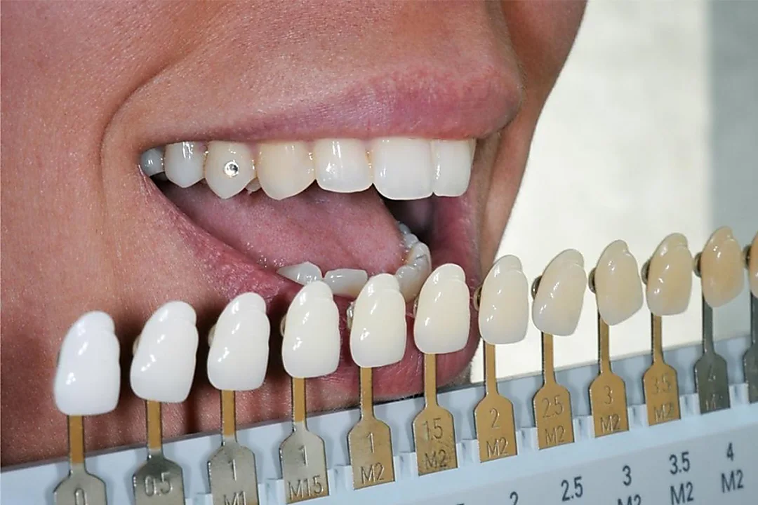 Impianti dentali a Rome: ecco il listino con i prezzi onesti