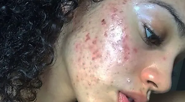 Ela acabou com a acne hormonal após descobrir um creme natural raro