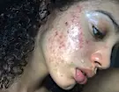 Ela acabou com a acne hormonal após descobrir um creme natural raro Ela acabou com a acne hormonal após descobrir um creme natural raro