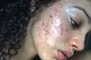 Ela acabou com a acne hormonal após descobrir um creme natural raro