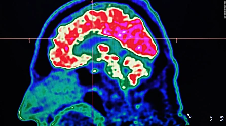 "Existe un tipo de demencia que es primariamente causada por la afasia", dice el Dr. Huerta sobre la condición que padece Bruce Willis | Video