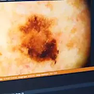 Μάθε για τους 3 βασικούς καρκίνους του δέρματος